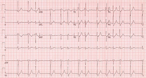 Atrial Fibrillation: symptoms, causes and treatment?