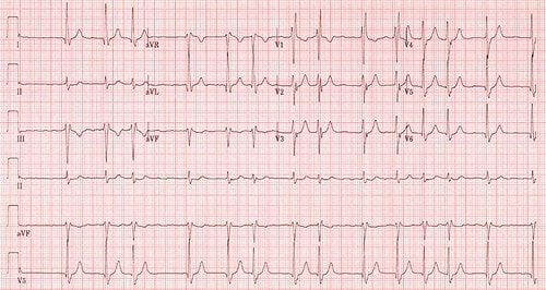 Atrial Fibrillation: symptoms, causes and treatment?